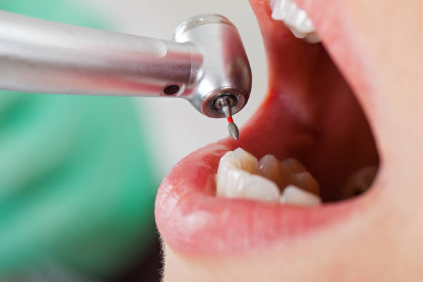 Best Broken or Chipped Tooth Repair in Monteagle, TN